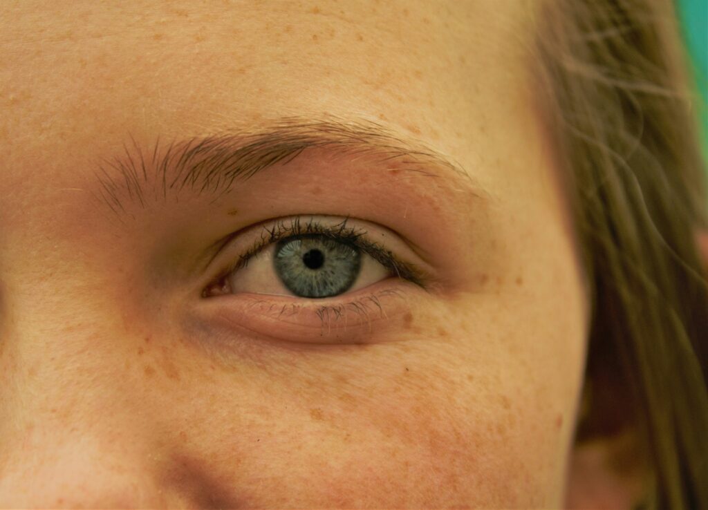 Close-up of a person's eye with natural under-eye shadows and skin texture, showing a realistic appearance before cosmetic enhancement.