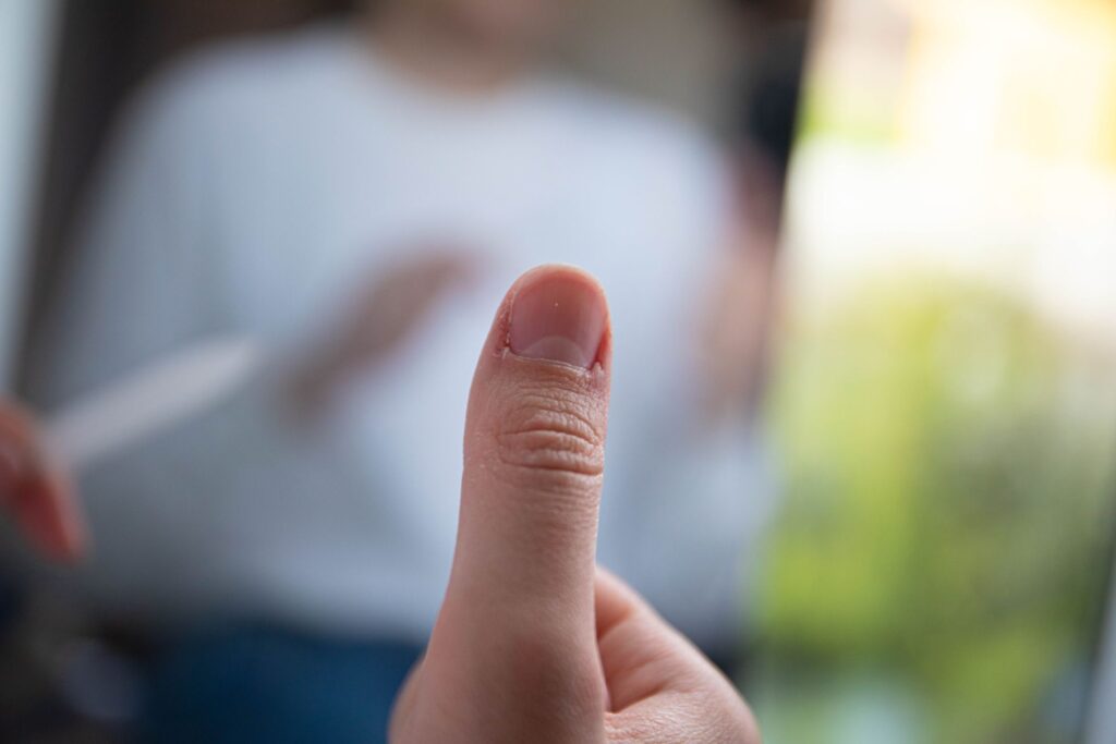 Close-up of damaged cuticle on thumb showing signs of overgrown and neglected nail skin.