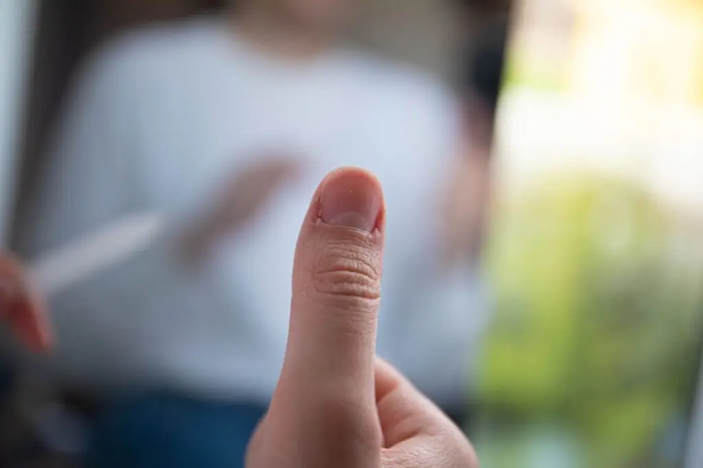 Close-up of damaged cuticle on thumb showing signs of overgrown and neglected nail skin.